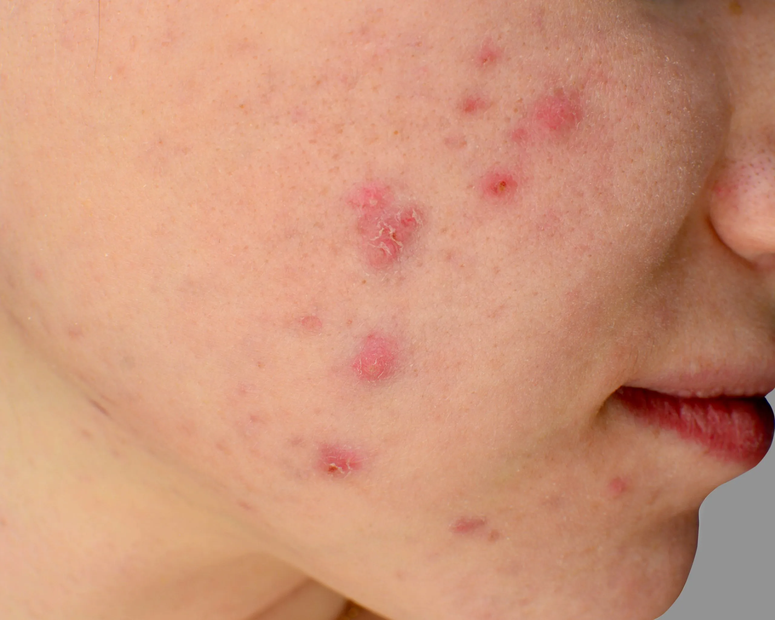 Acne skin because the disorders of sebaceous glands productions, Human skin Acne