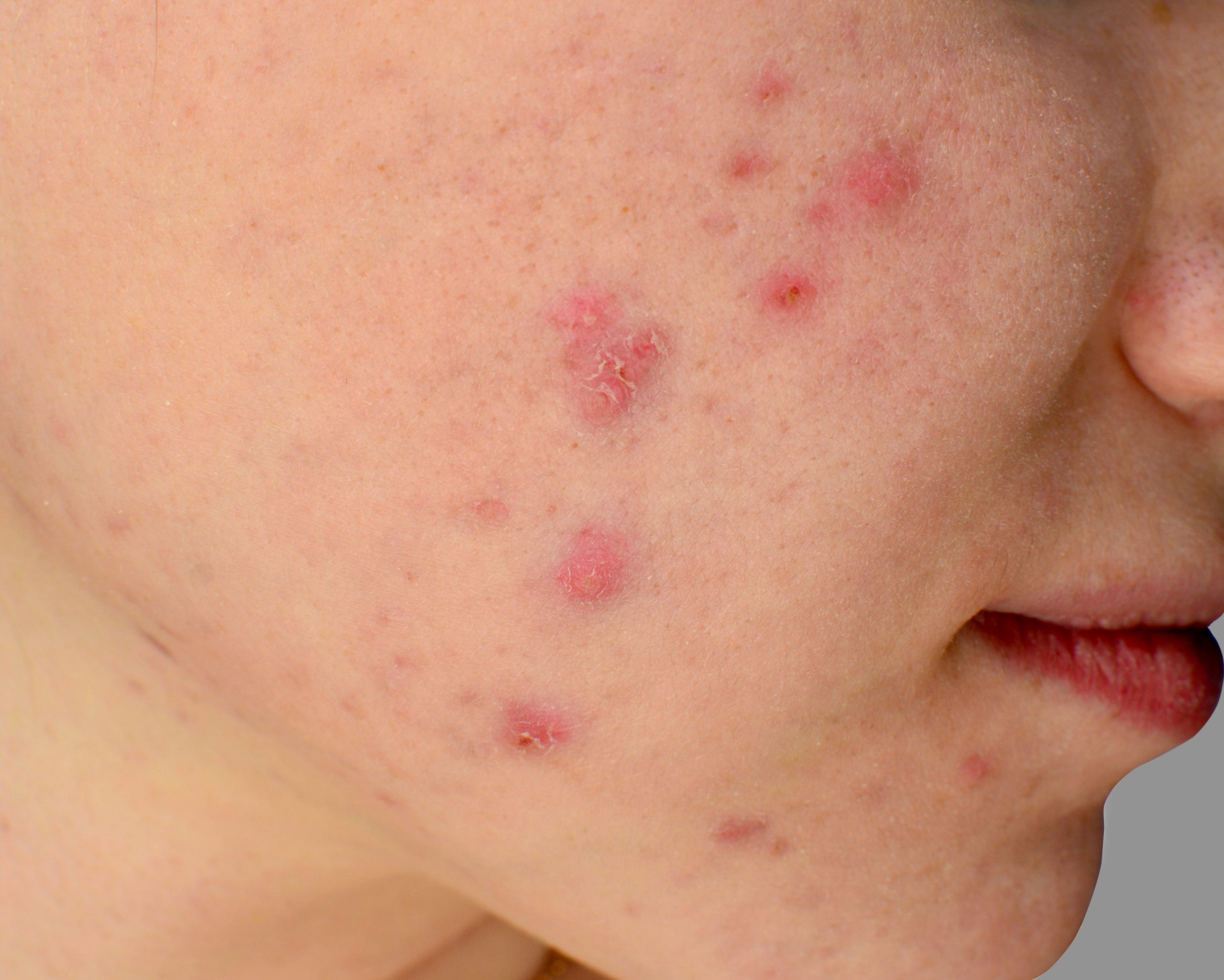 Acne skin because the disorders of sebaceous glands productions, Human skin Acne