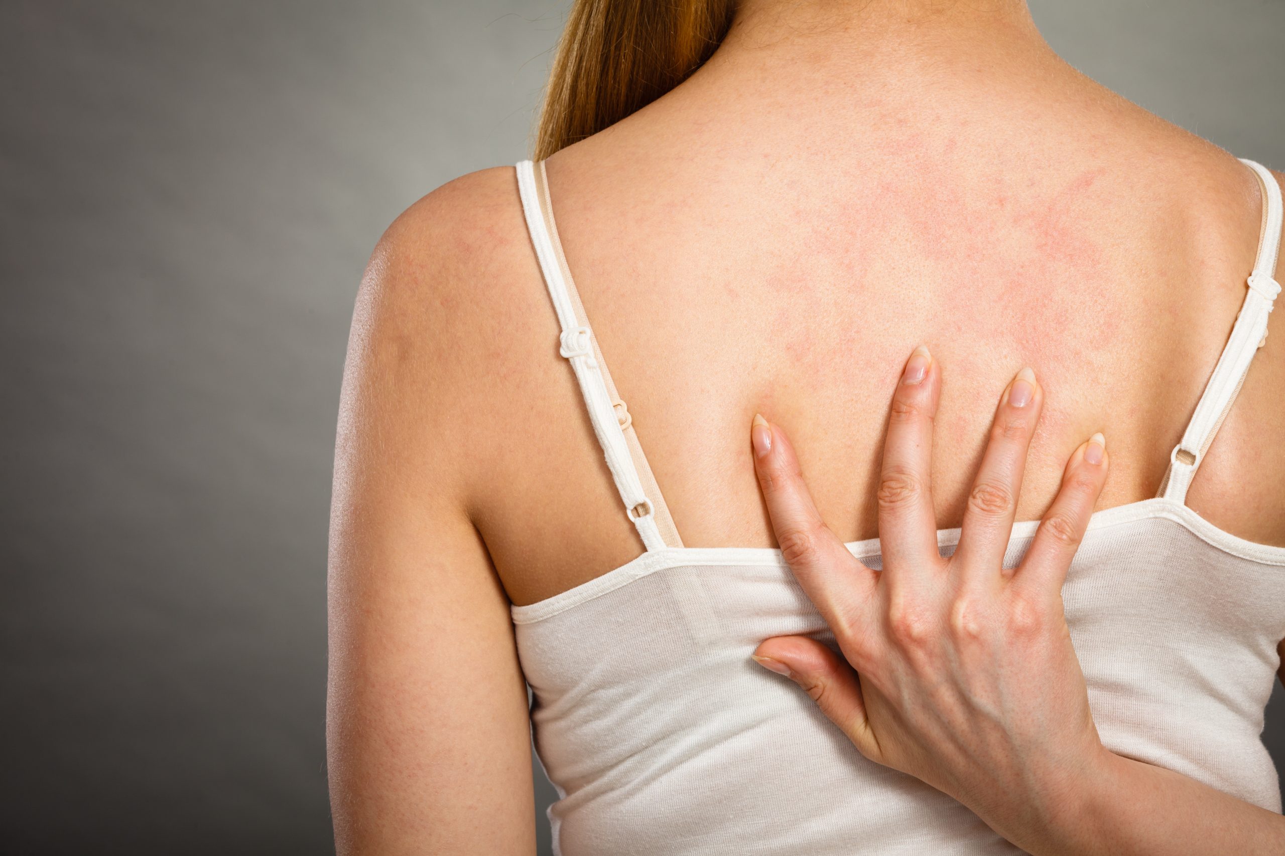 Health problem, skin diseases. Young woman showing her itchy back with allergy rash urticaria symptoms