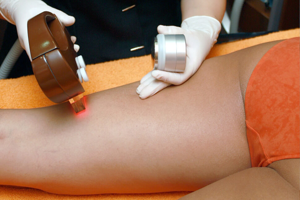 Laser Hair Removal