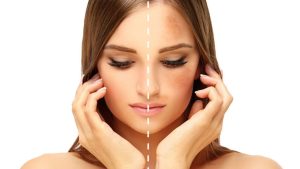 Prevent Pigmentation