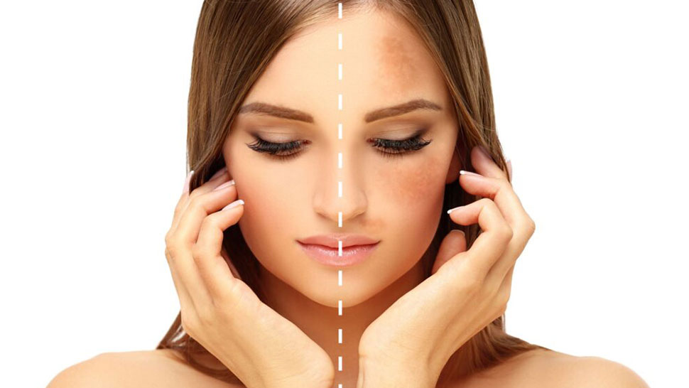Prevent Pigmentation