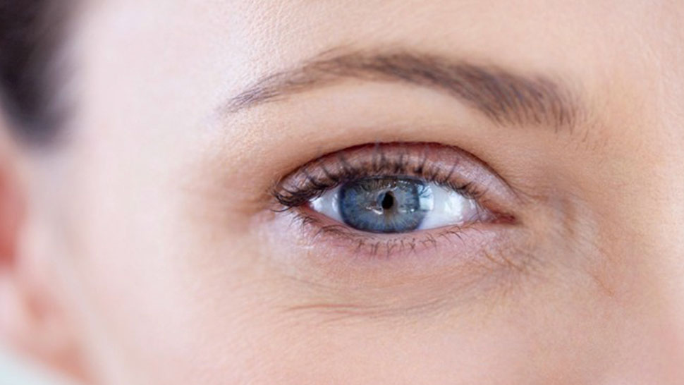 Under-Eye Wrinkles